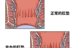 不同的痔疮都是怎么治疗的呢？图片