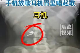 男子半夜睡觉误吞蓝牙耳机致胃里播放音乐 ，当事人：正在吃泻药，希望能排出来图片