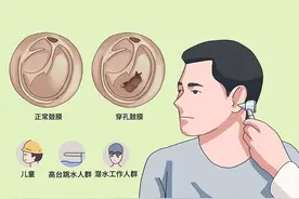 什么是鼓膜穿孔？鼓膜穿孔：听力的隐形杀手图片