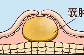 医生提醒：大多数囊肿无需处理，但若囊肿出现在5个地方，需警惕图片