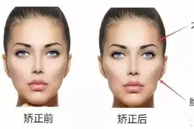 牙套脸到底是怎么一回事？图片