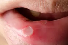 女子长期口腔溃疡，一查竟是牙齿“惹”的祸，多次治疗获得新生图片