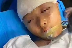 男教师用三角板打碎小学生头骨，家属称老师私自带孩子缝合，实际颅内还有残留物；父亲发声：仍在ICU图片