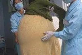 09年广东女子挺55公斤巨肚，怀孕11月未生，医生检查却看不见孩子图片