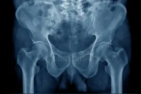 久坐引起的双侧髂骨致密性骨炎，保守治疗康复图片