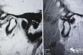 颞下颌关节盘移位和变形图片