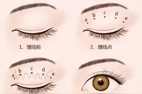 单眼皮肿眼泡为什么不适合埋线？全切效果又如何？图片