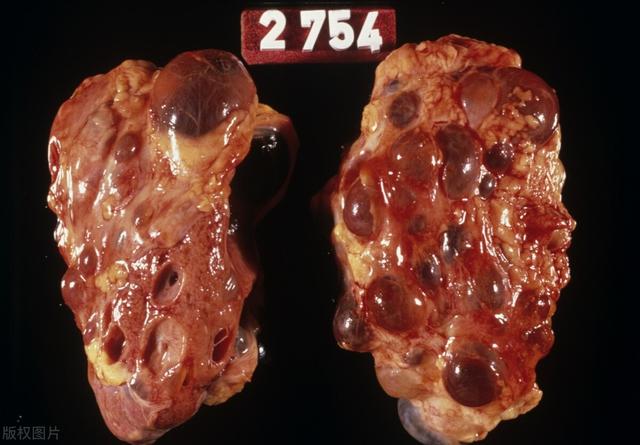 有4种肾病尿蛋白不算多,却尿毒症风险高!保护肾功能多注意2点