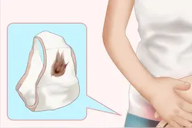 出现褐色分泌物是怎么回事？严重吗？图片