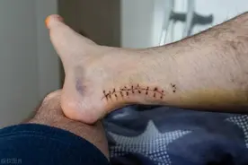 运动员之痛！跟腱断裂的诊断与术后康复图片