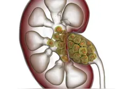 肾结石治疗方法，该如何选择？图片