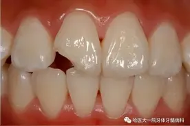 补牙， 知多少 什么样的牙齿需要修补；哪种材料适合我？图片