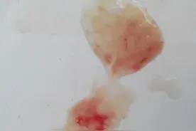 观痰知病并不难图片