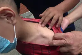 小男孩被502胶水粘住了！消防员三招应对，对你也有用图片