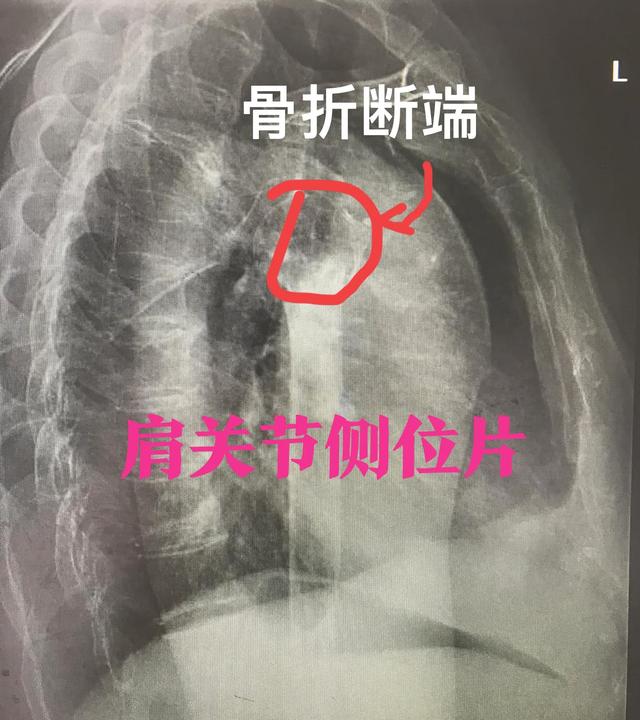 肱骨近端骨折系列之合并大结节撕脱性骨折治疗
