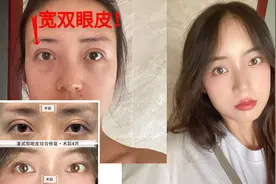 陕西女全切双眼皮失败总结：6年前跟风网红芭比眼，走上修复之路图片