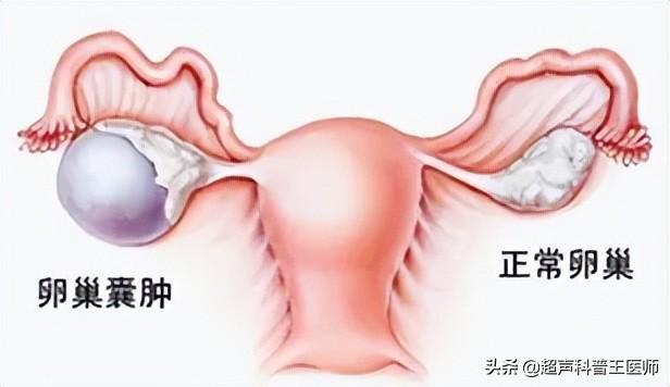 附件上有囊肿必须做手术吗（附件囊肿是什么需要手术吗）