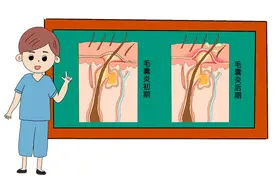 为什么头皮经常长疙瘩和脓包？3种皮肤问题很常见，别再抓了图片