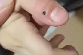 扎进手里的铅笔芯，会不会对身体产生伤害？图片
