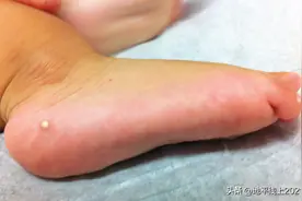 孩子脚上的小硬结是啥呢？图片