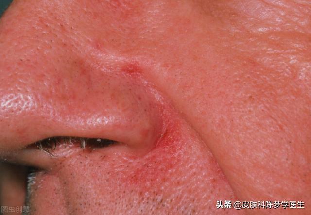 脸皮质角化