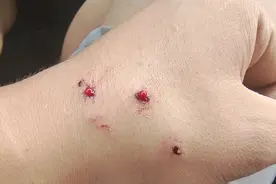 野外直播逗蛇被咬进ICU，这种花色的钓友们千万不要惹图片