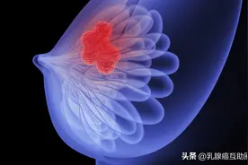 一文告诉你，什么是三阴性乳腺癌？图片