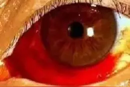 遭遇结膜下出血莫恐慌，专家教你这2个步骤图片