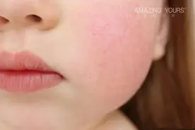 脸过敏发红痒怎么办｜美致时分图片