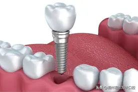 假牙也能用，为什么要去种牙？钱花不完？2分钟说明白图片