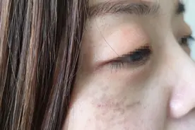 眼睑红肿瘙痒，是肾脏不好吗？图片