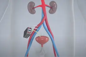 人工心脏都有了，为什么人工肾脏一直不出?图片