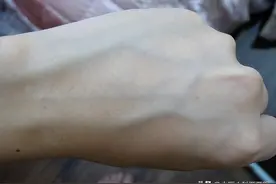 青筋凸起？说明体内积滞太多！不同部位凸起的青筋代表哪些问题？图片