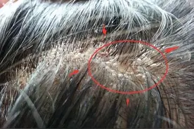 头皮为什么总长“脓包”和“疙瘩”？或与这4个因素有关，别大意图片
