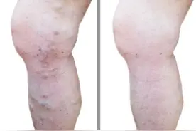 腿上爬“蚯蚓”，是静脉曲张了，一个千古名方，能有效缓解图片