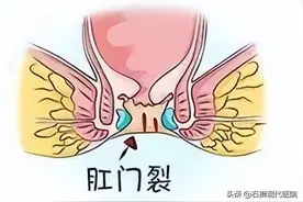 注意！排便时肛门剧烈疼痛，大便带血？您可能是肛裂了图片