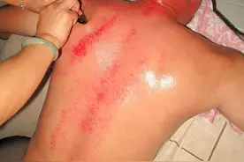 怎样正确操作中医保健中的刮痧和注意事项图片