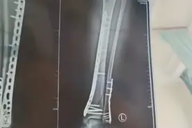 “增高洞洞鞋”致崴脚骨折，这个夏日流行单品要当心！图片