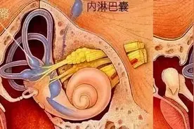 梅尼埃病图片