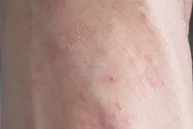 身上起红疙瘩而且痒的出奇，怎么回事？图片