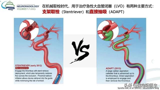 脑血栓如何治疗（脑血栓清除最常用的两种手术）