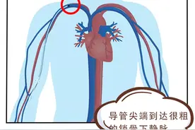 护理学科建设 | 中长导管小知识，你掌握了吗？图片