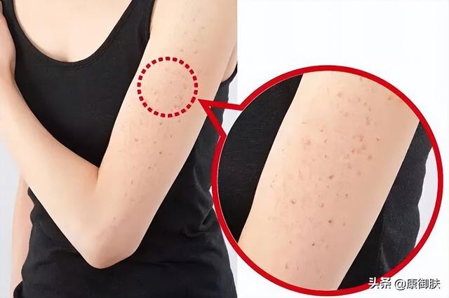 如何快速消灭鸡皮肤