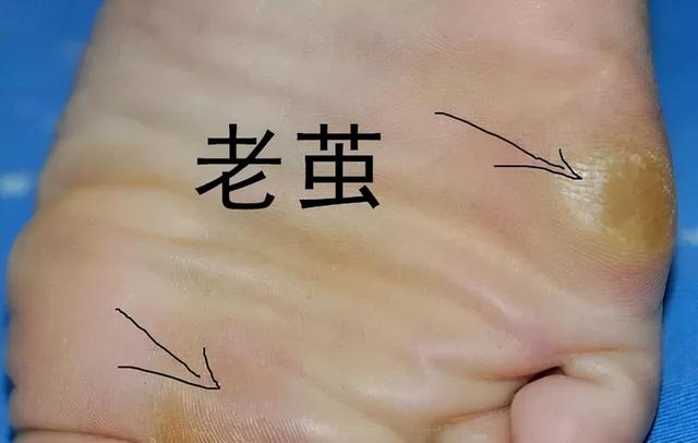 长了鸡眼怎么办，怎么治疗好？