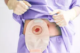 这是一篇关于肠造口的微介绍图片