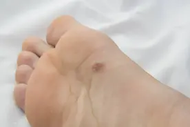 长在这些部位的痣，早除早放心图片