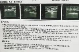 乳腺纤维瘤进行微创手术时B超提示钙化包膜不完整可能是恶性肿瘤图片