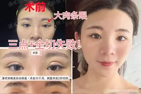 三点全切2次双眼皮后，94年姑娘不变美反成肉条眼，又一整形失败图片