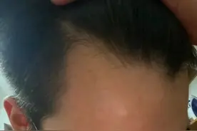 男生发量少，发际线秃，适合剪什么发型？图片