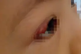 治疗“针眼”的“土办法”靠谱吗？这几个误区其实很常见图片